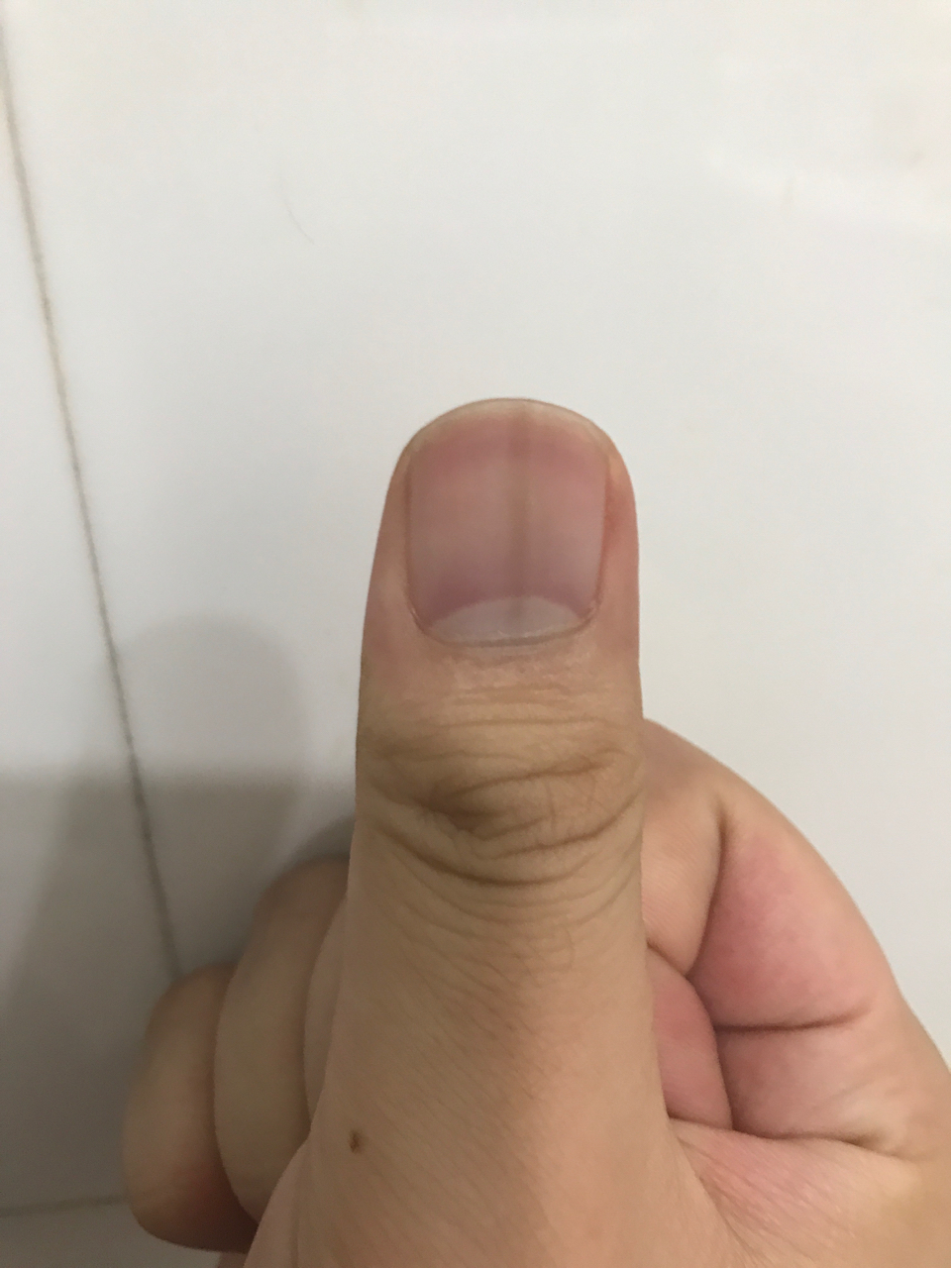 指甲有竖纹是什么病图片