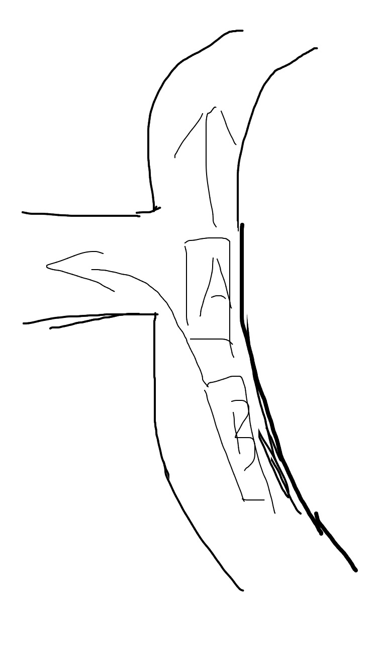 快到地的时候,我需要左转,前面车直行,由于是上坡加弯道,所以一直保持