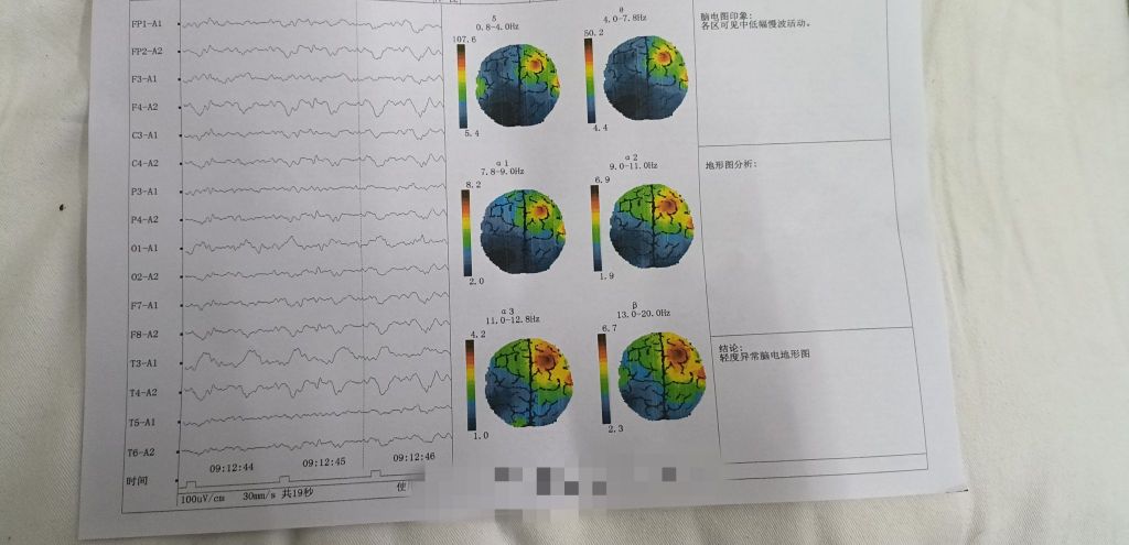 脑电图检查正常图片